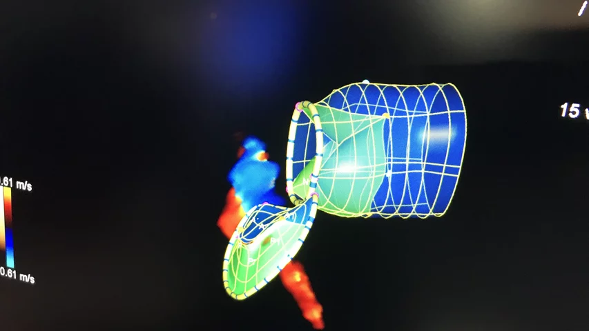 Example of mitral valve regurgitation on Siemens'  eSie Valves echocardiography analysis software. The system can automatically render the valve to show this view of the valve and the left ventricular outflow tract (LVOT), which is necessary for assessing patients for both surgical and transcatheter valve replacements. #ACC2022