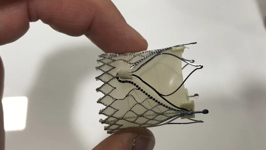 A closeup view of the JenaValve transcatheter aortic valve replacement (TAVR) device on display for the first time at ACC. It has European CE mark and it is now involved in a FDA IDE trial. It is designed to be used in patients without heavily calcified valve leaflets or annulus. It has 3 radiopaque markers to orientate it with the three valve cusps. It also has wire extensions that the native leaflets slide into and are clipped to in order to help anchor the self-expanding valve in the absence of calcium.
