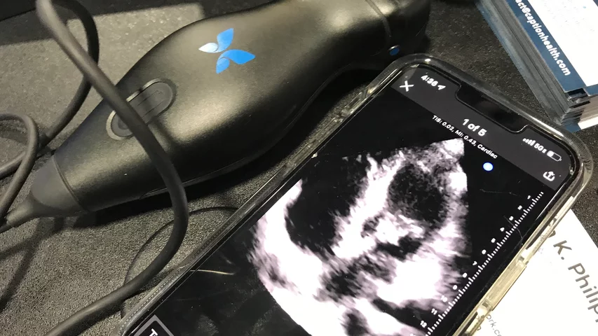 The Butterfly System point-of-care ultrasound (POCUS) system uses an app and a transducer to convert a smartphone or iPad into an ultrasound system. This was one of several POCUS systems on display at ACC.22. Butterfly has apps specific to several areas of anatomy, including vascular and cardiac. During COVID, POCUS exploded as a way to get quick looks inside COVID patients with an easy to sterilize imaging system that would not interfere with tubes, ventilators and other equipment. #ACC2022