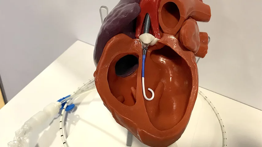 This is a model in the Abiomed booth showing the positioning of an Impella percutaneous hemodynamic support pump in the left ventricle. The pump, inserted via the femoral artery, can offer more support than an IABP. The company created its own database of studies and registry data showing  improved outcomes when used in patients with severely reduced ejection fractions, in need of support during protected PCI, or in cardiogenic shock. #ACC22