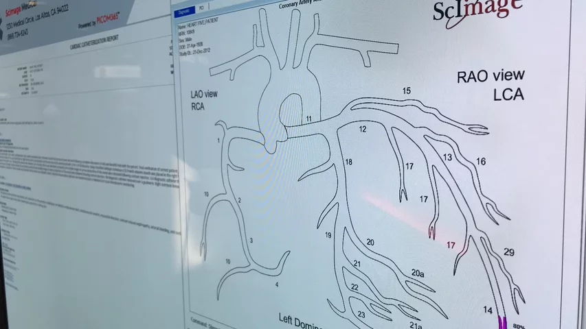 A pop-up interventional cardiology coronary tree diagram that can be annotated with stents, areas of obstructive lesions and measurements that is part of the cath reporting system in the ScImage cardiovascular information system (CVIS). Some vendors offers systems like this that will auto complete sections of the cath report based on the information entered during the procedure and from annotations on the coronary tree. This can help speed report completion. 