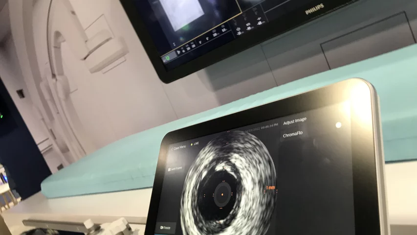 Integration of table side control for IVUS on Philips' Azurion angiography platform can help reduce carts in the cath lab and make it easier for the interventional operator. 