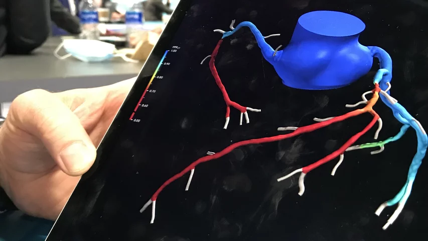 An example of a HeartFlow FFR-CT 3D rendering of a patient's coronary tree from their cardiac CT scan. A virtual, non-invasive fractional flow reserve (FFR) ratio is calculated using AI and computational fluid dynamics, rather than the current standard of care using an invasive pressure wire in the cath lab. The color codes show areas of dropping hemodynamic flow, with red areas being below acceptable levels, where the patient is experiencing ischemia. #ACC2022