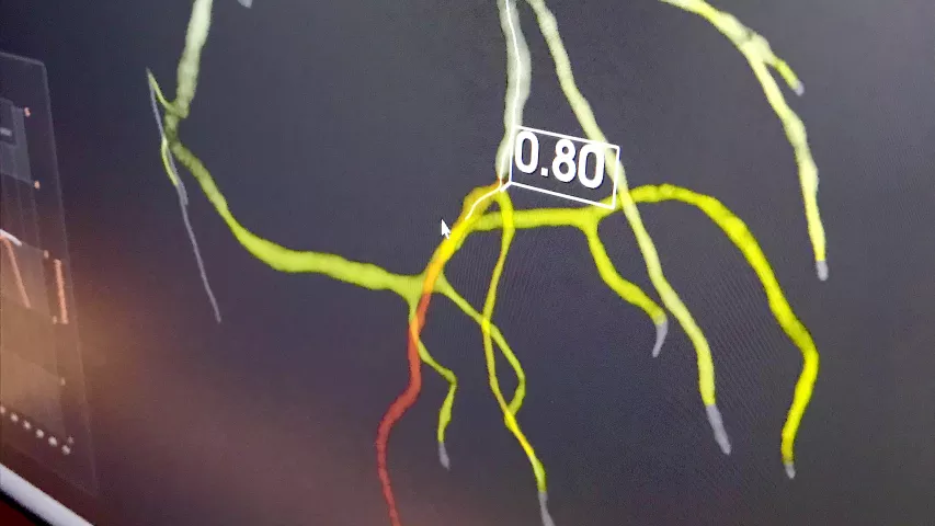 South Korean start-up artificial intelligence company AIMedic displayed its work-in-progress CT angiography algorithm that can derive FFR-CT values for the entire coronary tree in about 30 minutes. The vendor said this can be done onsite without sending datasets offsite using a small server. The company does not have FDA and was gathering feedback from physicians at SCCT.
