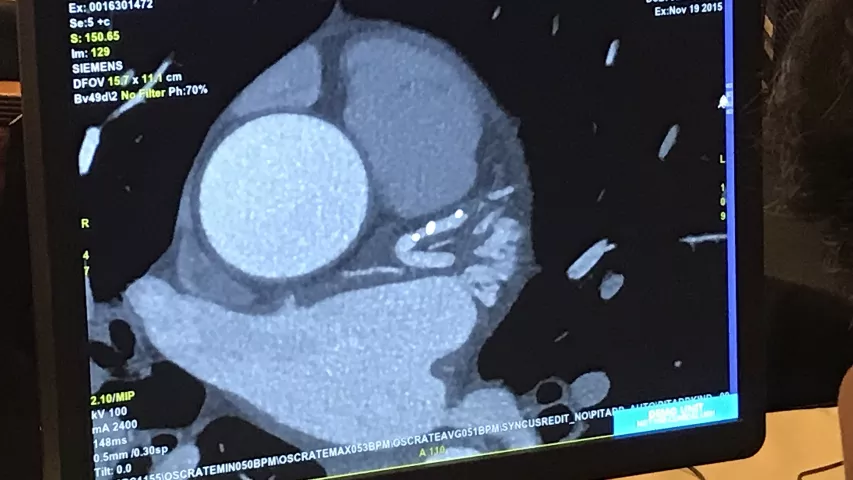 An unusual finding on a cardiac CTA showing the radio-opaque markers for the ends of an Absorb bioresorbable stent, where the stent has completely dissolved, leaving behind only the markers. In the treated area is a calcified lesion showing where the ruptured plaque healed. The stent is no longer on the market due to low usage. #SCCT #SCCT2022 #yesCCT #CCTA #CTA