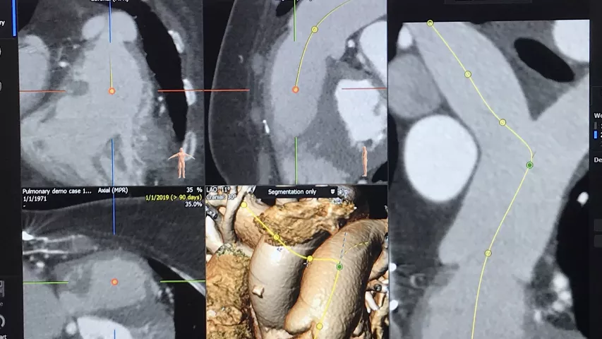 CT planning case for implantation of a transcatheter a pulmonary valve on CT pre-procedural assessment in a session on structural heart planning at the Society of Cardiovascular Computed Tomography (SCCT) 2022 meeting last week. The software used in this session was 3mensio, which enables the imager to find the center lines of the vessels and valves, measure the annulus and to perform a virtual implant of various commercial valves (Melody, Harmony, Sapien) of different sizes. #SCCT #SCCT2022 #yesCCT