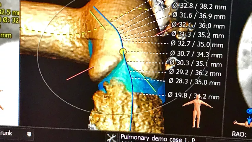 Virtual implantation of a pulmonary valve on CT pre-procedural assessment software in a session on structural heart planning today at the Society of Cardiovascular Computed Tomography (SCCT) 2022 meeting in Las Vegas. The software used in this session was 3mensio, which enables the imager to find the center lines of the vessels and valves, measure the annulus and to perform a virtual implant of various commercial valves (Melody, Harmony, Sapien) of different sizes. #SCCT #SCCT2022 #yesCCT #cardiacCT
