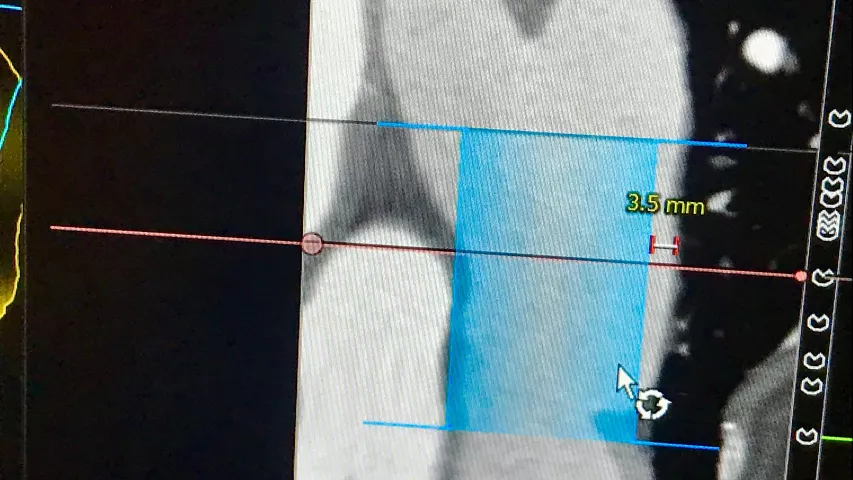 Virtual implantation of a pulmonary valve on CT pre-procedural assessment software in a session on structural heart planning today at the Society of Cardiovascular Computed Tomography (SCCT) 2022 meeting in Las Vegas. The software used in this session was 3mensio, which enables the imager to find the center lines of the vessels and valves, measure the annulus and to perform a virtual implant of various commercial valves (Melody, Harmony, Sapien) of different sizes. #SCCT #SCCT2022 #yesCCT #cardiacCT