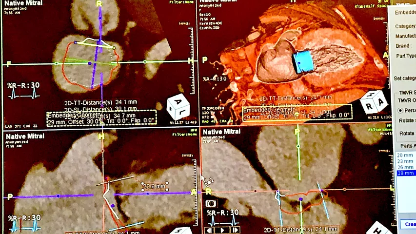 Virtual implantation of a mitral valve using the Intuition advanced visualization software during CT pre-procedural structural heart planning seminar at the Society of Cardiovascular Computed Tomography (SCCT) 2022 meeting. Use of virtual implants is growing to get a better idea of how different size devices fit the anatomy and what complications they might present, such as left ventricular outflow tract (LVOT) obstruction, and to calculate  neo-LVOT area in TMVR. #SCCT #SCCT2022 #yesCCT #cardiacCT