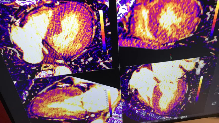 Advanced visualization for CT of the myocardium demonstrated in the Ziosoft booth on the expo floor.#SCCT #SCCT2022 #yesCCT #cardiacCT