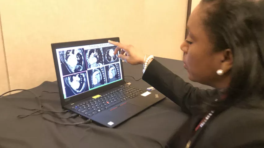 Renee Bullock-Palmer, MD, FACC, FAHA, FASNC, FASE, FSCCT, director of noninvasive cardiac imaging and the women's center at Deborah Heart and Lung Center, explains a complex congenital case. She presented on how CTA can be used to help assess congenital patients and better understand the anatomy prior to interventions. #SCCT #SCCT2022