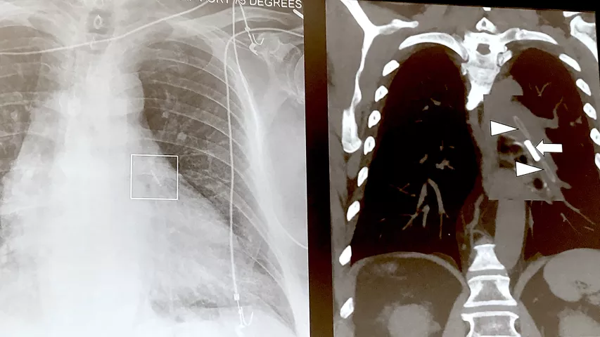 An example of a CardioMEMS implanted heart failure monitor in the pulmonary artery seen in a cardiac CT scan during a presentation at SCCT. Jody Shen, MD, Stanford, presented on uncommon device technologies that pop up on cardiac and CT exams that imagers need to be aware of. She said this device is identified by its wire loops attached at either end. #SCCT #CardioMEMS