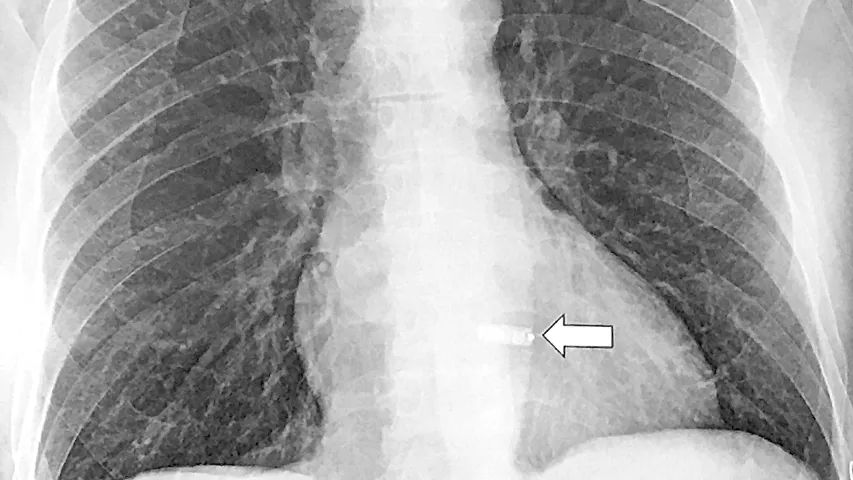 An example of a CT scout scan showing a metallic object inside the heart. Jody Shen, MD, Stanford, explained in her session this a transcatheter, leadless pacemaker, which will likely be a more common sight as these devices see wide use. She presented on uncommon device technologies that pop up on cardiac and CT exams that imagers need to be aware of.  #SCCT2022