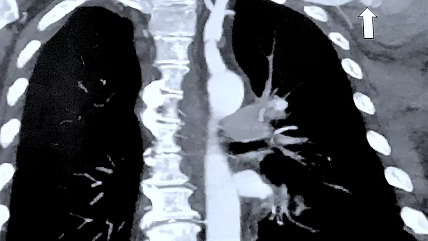 Example on CT of an intra-aortic balloon pump (IABP) accidentally positioned in the wrong vessel, resulting in aneurisms and pseudo aneurisms due to the excess pressure. Jody Shen, MD, Stanford, presented on uncommon device technologies that pop up on cardiac and CT exams that imagers need to be aware of. #SCCT2022