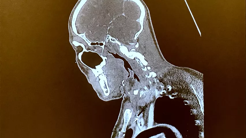 CT showing an intra-aortic balloon pump (IABP) inflated in the aortic arch. Jody Shen, MD, Stanford, presented on uncommon device technologies that pop up on cardiac and CT exams that imagers need to be aware of. #SCCT #SCCT2022 #CCTA