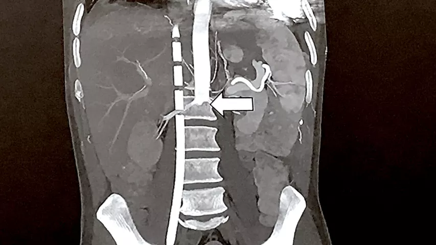 VA-ECMO can cause issues in cardiac CT evaluations because it changes the blood flow patterns in the body. This example was presented in a sesssion by Jody Shen, MD, Stanford. They show how contrast does not flow normally and there can appear to be an obstruction like a clot, but it is caused by the reversal of flow by ECMO. She said to get the contrast to go lower in the body, you may have to reduce the ECMO flow during the exam. #ECMO #CCTA #SCCT #SCCT2022