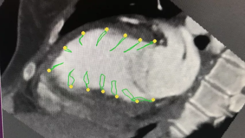An example of cardiac CT myocardial strain imaging shown in sessions. The vendor Medis also demonstrated this technology of the show floor. It is similar to more commonly used echo strain imaging, which is used to gain more insight into a patient's cardiac function, and is a measure used to cardio-oncology monitoring of cardio-toxicity in patients under going cancer therapy. MRI is also commonly used in serial exam followup, but for patients who cannot undergo MRI, CT is an option. #SCCT2022 #CTstrain