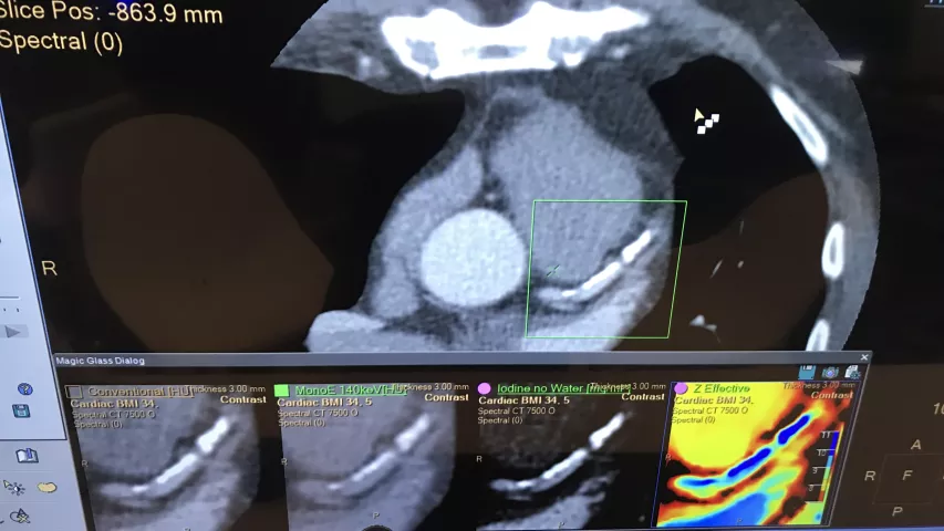 Example of CT spectral imaging from Philips Healthcare, showing a heavily calcified coronary vessel at different energies so the reader can see which offers the best view past the calcium. #SCCT2022 #SCCT #SpectralCT #CCTA
