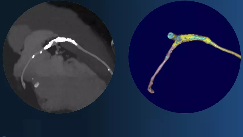 Left, coronary CT angiography of a vessel showing plaque heavy calcium burden. Right, image showing color code of various types of plaque morphology showing the complexity of these lesions that was automatically created using artificial intelligence. Cardiac AI vendor Elucid has developed the now FDA-cleared algorithm to automatically assess a coronary CT scan to identify all the plaque in the vessels, classify it and create a report with images. #SCCT #SCCT2022 #CCTA #AIcardiology