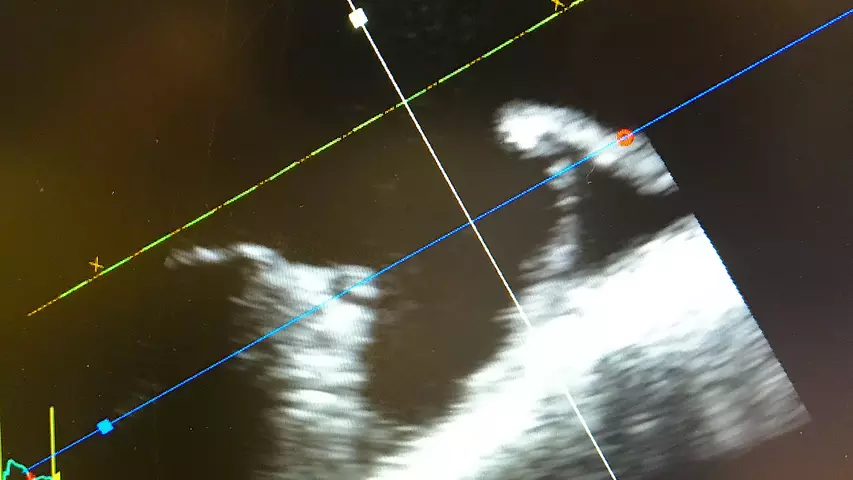 A 4D intracardiac echo (ICE) view of a left atrial appendage for sizing a Watchman device using the GE S70N ultrasound system. 