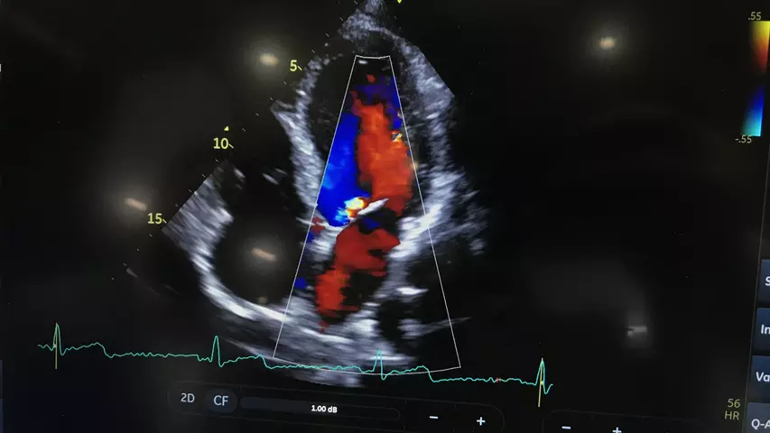 Example of mitral regurgitation seen on an echocardiogram using Doppler flow on a GE Vivid IQ system. #ACC