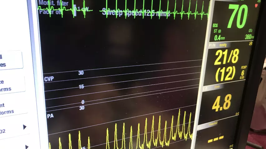 A PA catheter hemodynamic waveform measuring pulmonary artery pressures as part of a hands-on cardiac critical care simulator at ACC.23. #ACC23
