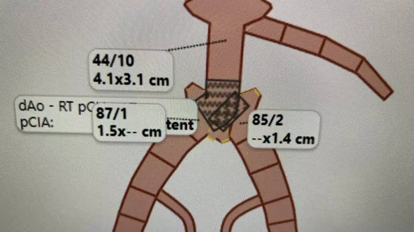 Aorta artery diagram for CVIS interventional reporting shown by Fujifilm at HIMSS 2023. Photo by Dave Fornell