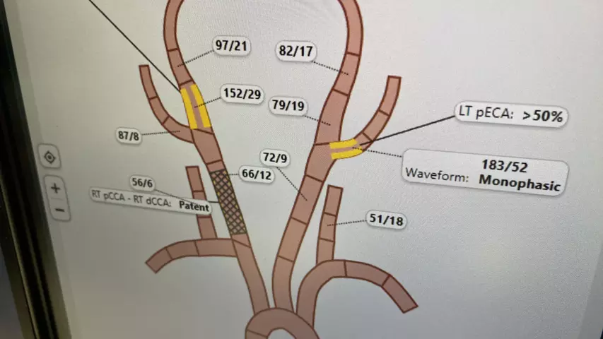 An interactive diagram for the carotids and arteries of the brain for interventional reporting shown by Fujifilm at HIMSS 2023. Photo by Dave Fornell