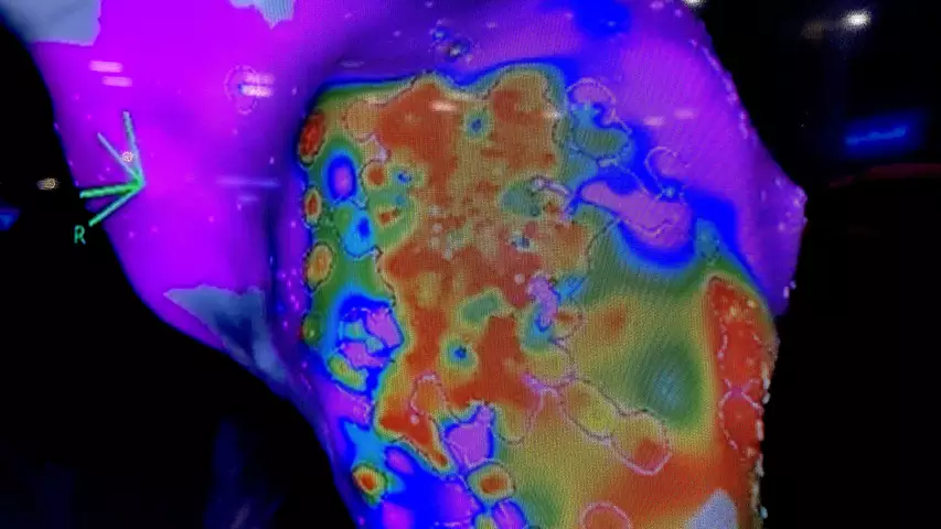 Biosense Webster Optrell EP ablation electro mapping catheter on display at HRS 2023. Photo by Dave Fornell