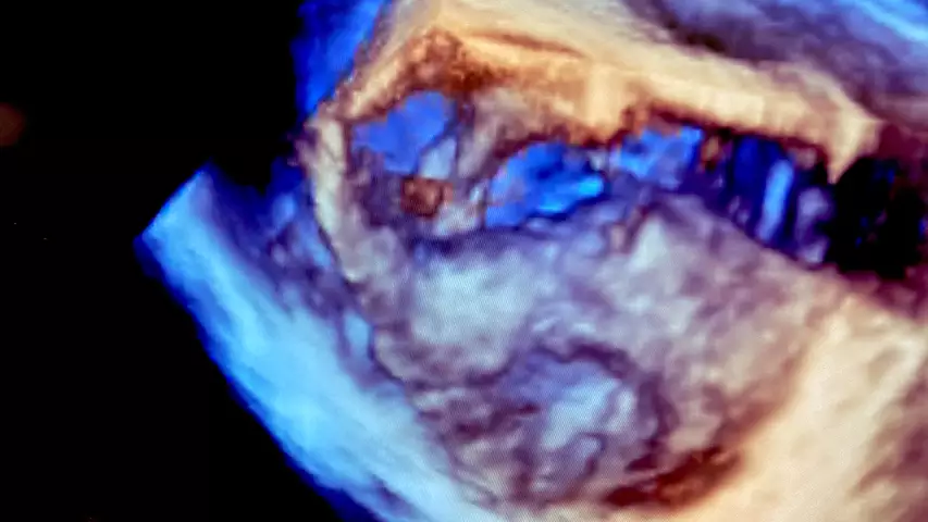 An example of 3D ICE showing a vegetation clot formed on a valve using the Philips ICE system in a demo at ASE.