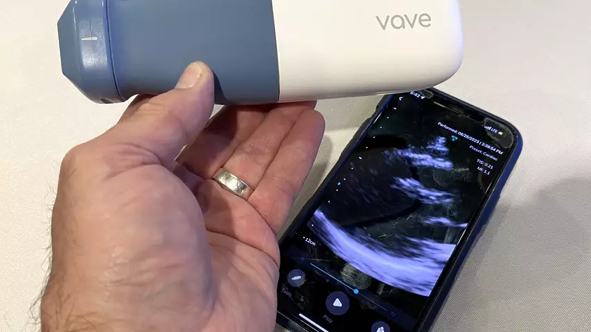 The Vave wireless POCUS ultrasound probe works with an app to turns a smartphone into an ultrasound system.