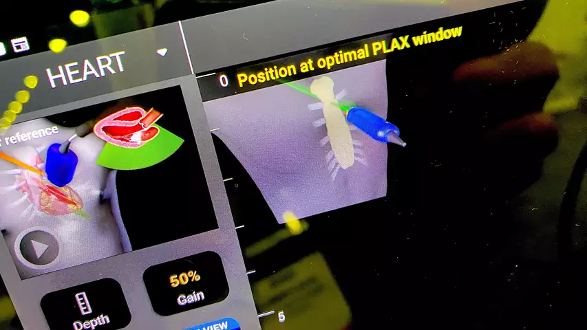 Example of AI-assisted echo exam guidance on the Echonous Kosmos POCUS system. The thumbnail picture of the chest, target area and transducer show the user how to position and move the transducer to get better quality cardiac images.