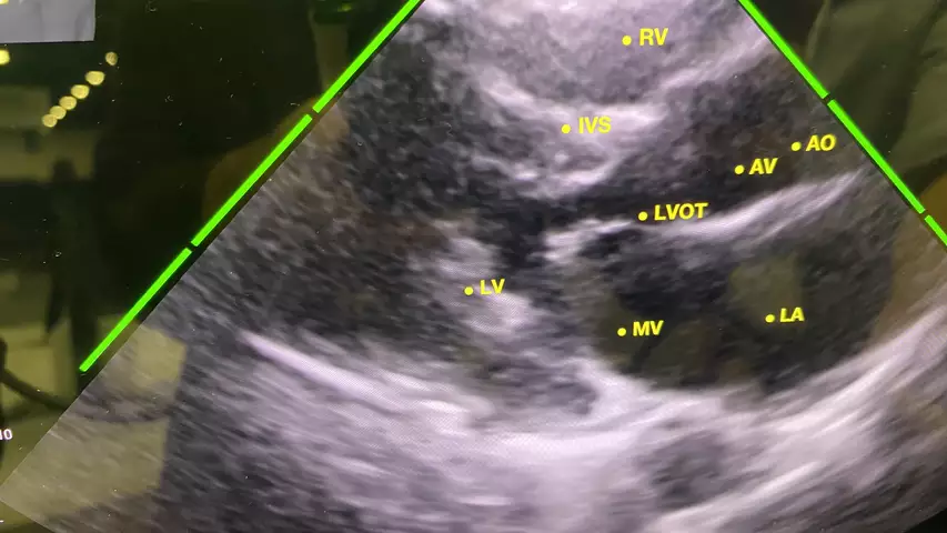 Echonous Kosmos POCUS AI guidance to perform echo exam ASE23. An example of AI guidance technology to help novice ultrasound users perform a diagnostic quality echo on the Echonous Kosmos POCUS system. The green bars show the quality of the imaging window and anatomy to capture imaging of the heart is specific views. The system also has a thumbnail image of the chest and transducers to show how to move it to get the correct views.