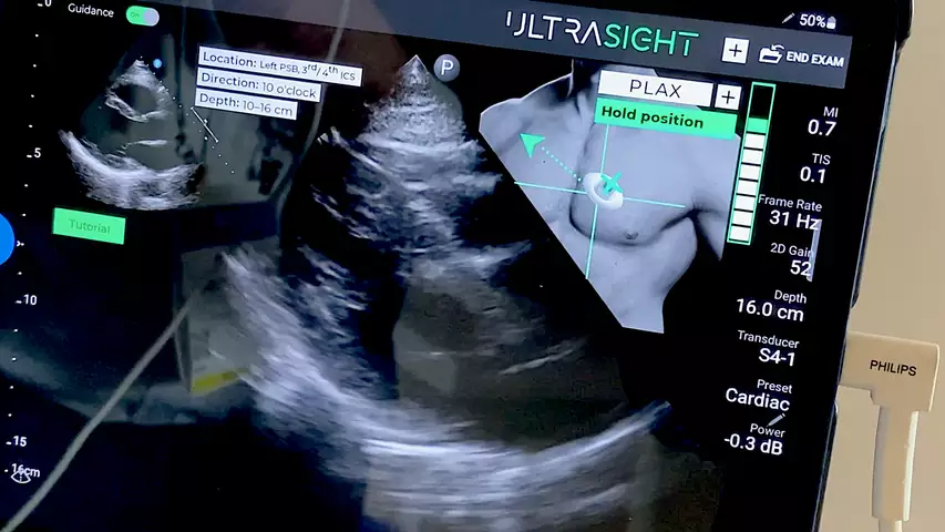 Example of a live POCUS cardiac scan with AI guidance technology to help the user get diagnostic quality echos using the Ultrasight AI system. The AI uses a thumbnail image of the chest and transducer with a target area marked to show where and how to move the transducer. A bar graph on the right side of the thumbnail image shows the quality of the image being acquired and will go up has the user gets into a more ideal imaging window with the correct anatomy in frame. 