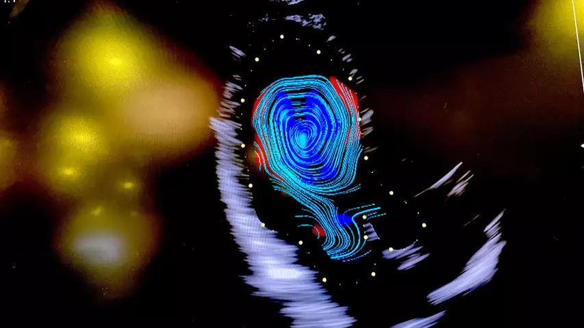 Vortice on Streamline view of Vector flow imaging echo ultrasound Fujifilm 2023 ASE.