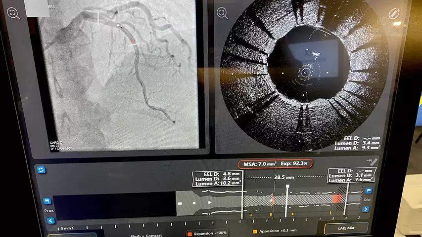 The HyperVue OCT-NIRS intravascular imaging system. This system allows for deeper imaging in the vessel walls than traditional OCT systems. It also combines near-infrared spectroscopy to determine the chemical makeup of the soft plaques to determine if they are stable or unstable, which adds more diagnostic information than the anatomical imaging alone. OCT has higher resolution than IVUS so it is easier for most operators to clearly understand what they are looking at. Photo by Dave Fornell