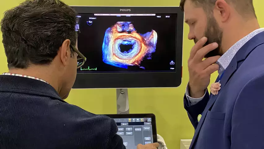 Mitral valve on 3D/4D echocardiography demonstrated on the Philips Epiq system. Photo by Dave Fornell