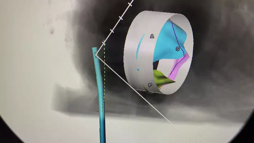 Transcatheter tricuspid valve planning on CT scans using the 3mensio CAAS software at TCT 2023. The software allows placement of different sized valve shapes to determine sizing and how it will sit within the anatomy. The software also has planning tool for where to place TEE probes to get optimal imaging. Photo by Dave Fornell