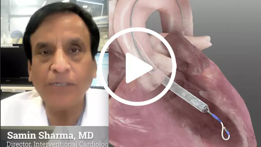 Initial results promising for world's smallest percutaneous heart pump