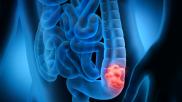 colon colorectal cancer CTC