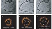  (OCT) intravascular images (bottom).