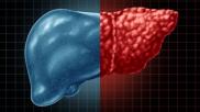 fatty liver disease hepatic steatosis 