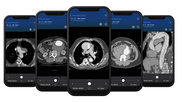 Examples of CT imaging showing aortic dissections on an acute AAA response team app that was recently cleared by the FDA from Viz.AI. 