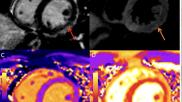 COVID-19 vaccine associated myocarditis on short-axis 1.5T MRI images of a 19-year-old man who presented with chest pain three days following the second dose of an mRNA COVID-19 vaccine.