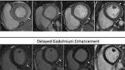 Myocarditis as seen on cardiac MRI in patients who recently received COVID-19 messenger RNA vaccination from a November 2021 imaging study. Image courtesy of the American Journal of Roentgenology (AJR)