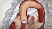 The Edwards Lifesciences Sapien transcatheter aortic valve replacement (TAVR) device in a heart model used to show patients how the device works.