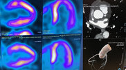 The ASNC is one of several medical imaging societies asking Congress to repeal the appropriate use criteria (AUC) criteria mandate. They say it poses issues for clinicians and is becoming outdated by changes in CMS payment systems. The AUC requirements call for documentation using CVMS authorized software in order to show advanced imaging such as nuclear and CT is justified, or else Medicare payments might be withheld.
