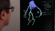 Heartflow FFR-CT allows noninvasive assessment of a patient'c coronary arteries without the need for a diagnostic angiogram.