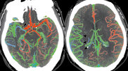 Ischemic stroke CT scan showing color coded blood flow for early and later arterial and venous contrast phases and areas of blocked blood flow. Image courtesy of RSNA