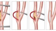 Carotid endarterectomy (CEA) is not associated with a significant reduction in the risk of dementia, according to a new analysis published in the European Journal of Vascular & Endovascular Surgery.[1] However, the study’s authors noted, it did still lead to considerable improvements in stroke risk. 